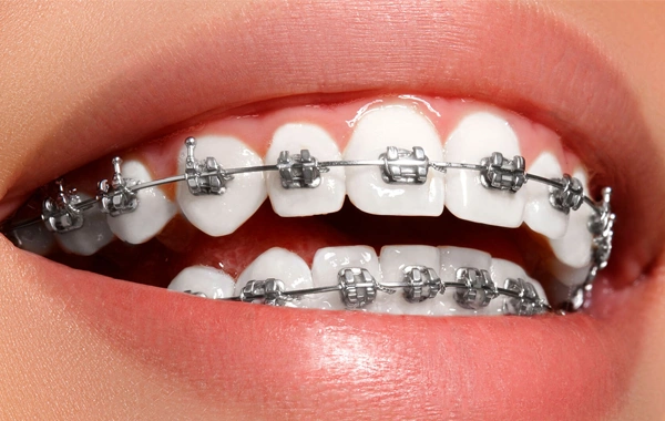 aparelho ortodôntico