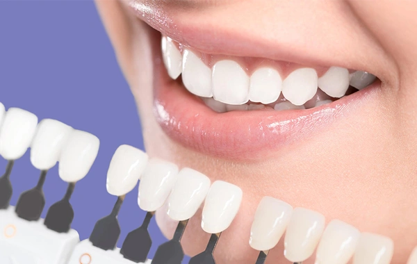 Paciente sorrindo após colocar lente de contato dental