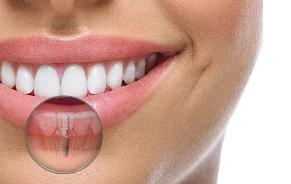 Implantes Dentários